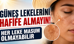 Güneş Lekelerini Hafife Almayın: Her Leke Masum Olmayabilir