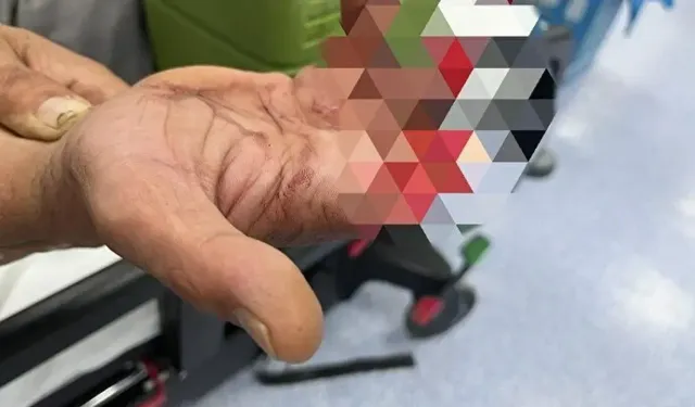 Feci kazada parmakları koptu