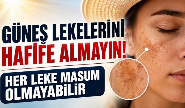 Güneş Lekelerini Hafife Almayın: Her Leke Masum Olmayabilir