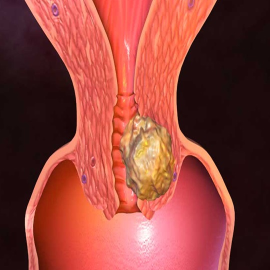 Rahim Ağzı Kanserinde Erken Tarama Hayat Kurtarıyor (1).Jpg