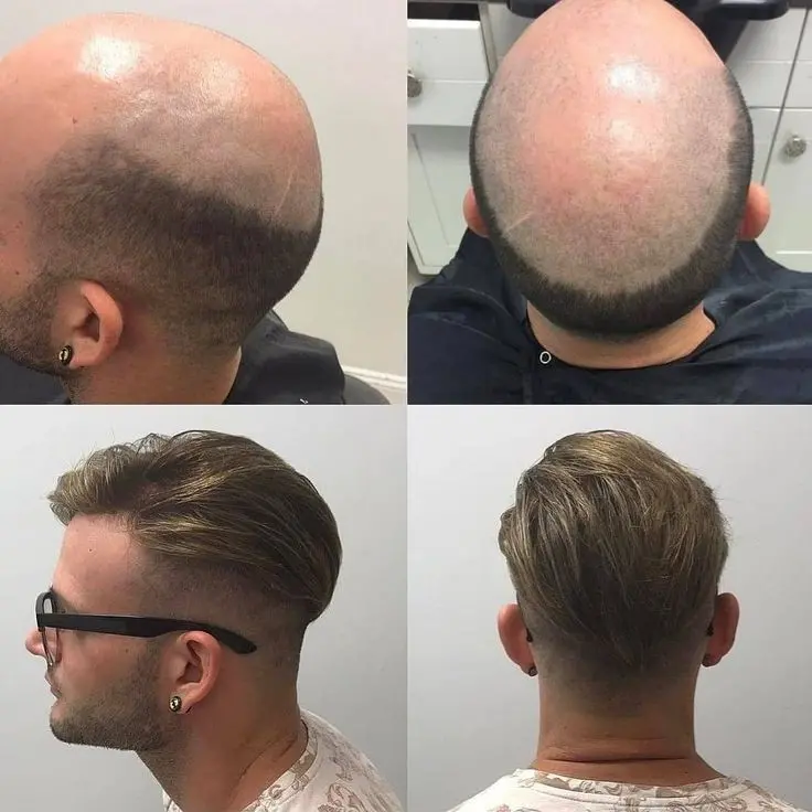 Isparta’da Protez (5)